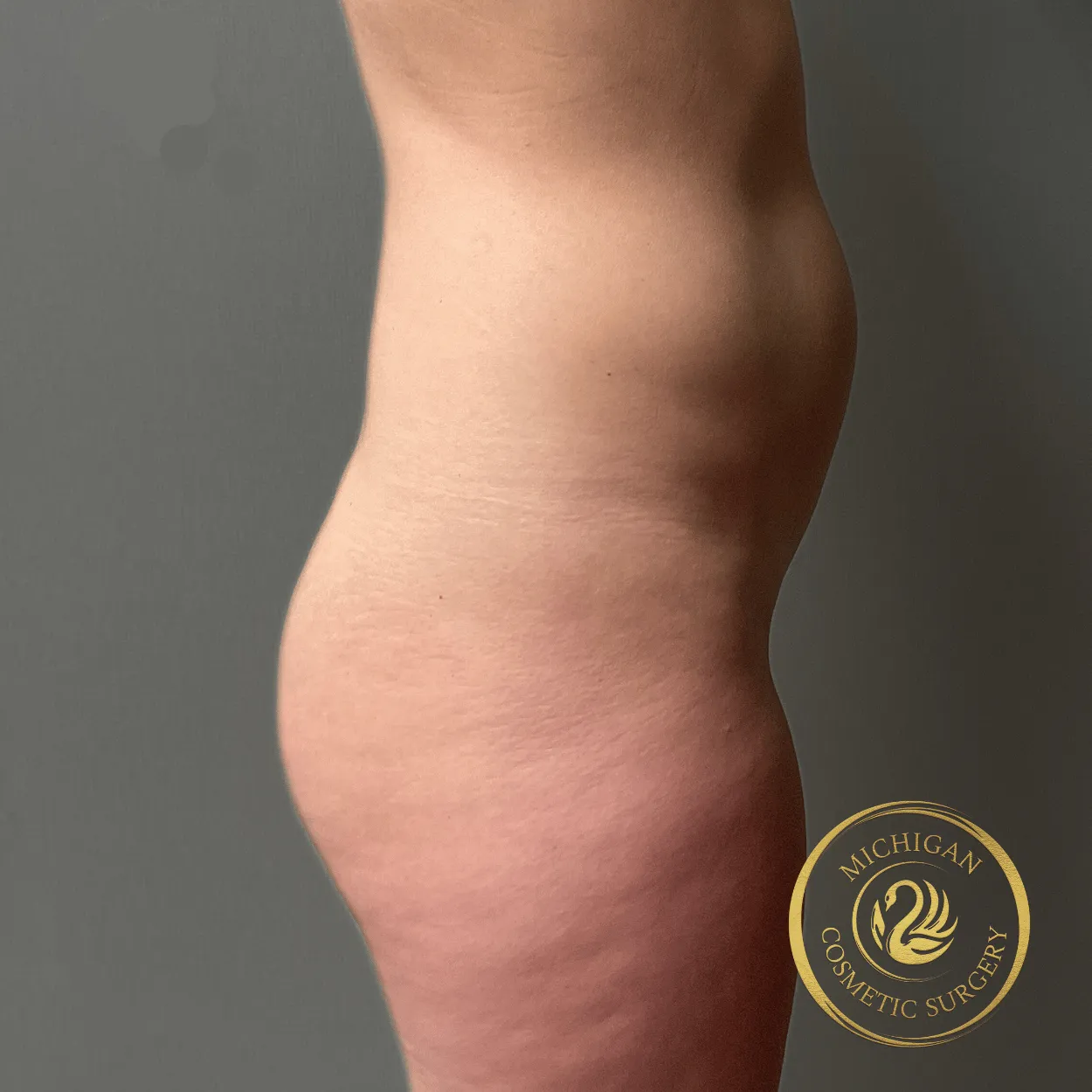 liposuction before photo by michigan cosmetic surgery in southfield mi