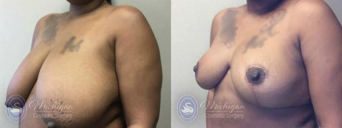 Breast Reduction Michigan
