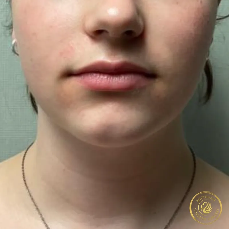 chin liposuction after photo by michigan cosmetic surgery in southfield mi