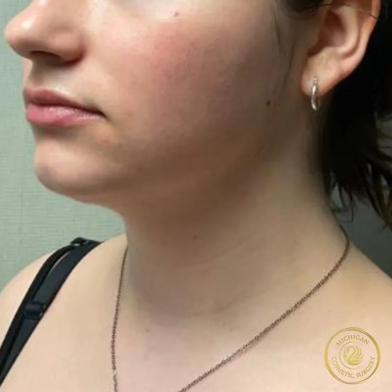 chin liposuction after photo by michigan cosmetic surgery in southfield mi