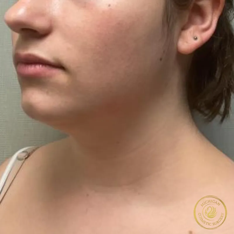 chin liposuction before photo by michigan cosmetic surgery in southfield mi