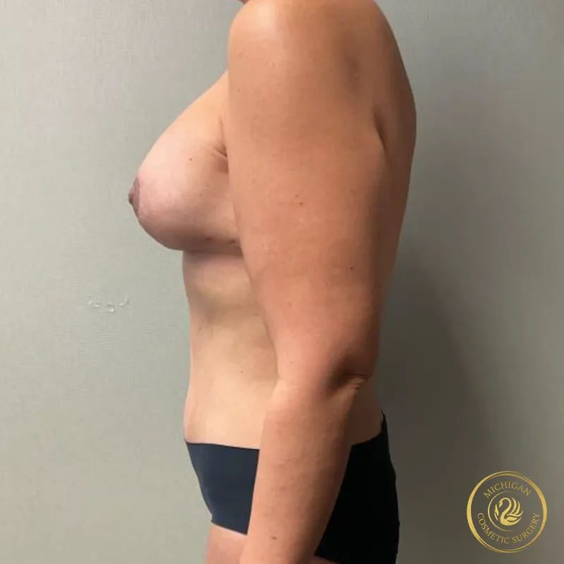 mommy makeover after photo by michigan cosmetic surgery in southfield mi