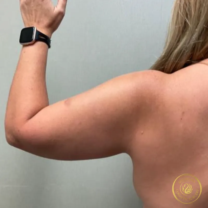 liposuction before photo by michigan cosmetic surgery in southfield mi