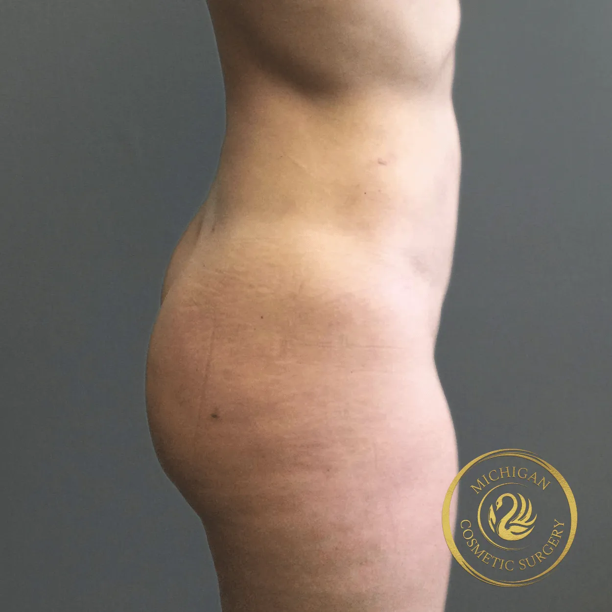 liposuction after photo by michigan cosmetic surgery in southfield mi