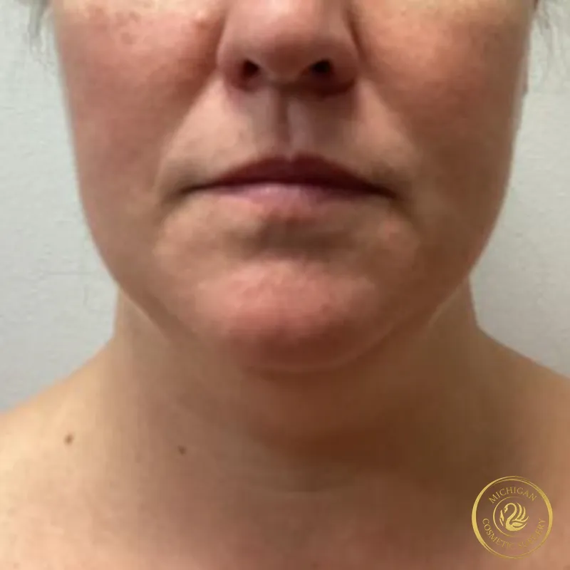 chin liposuction before photo by michigan cosmetic surgery in southfield mi