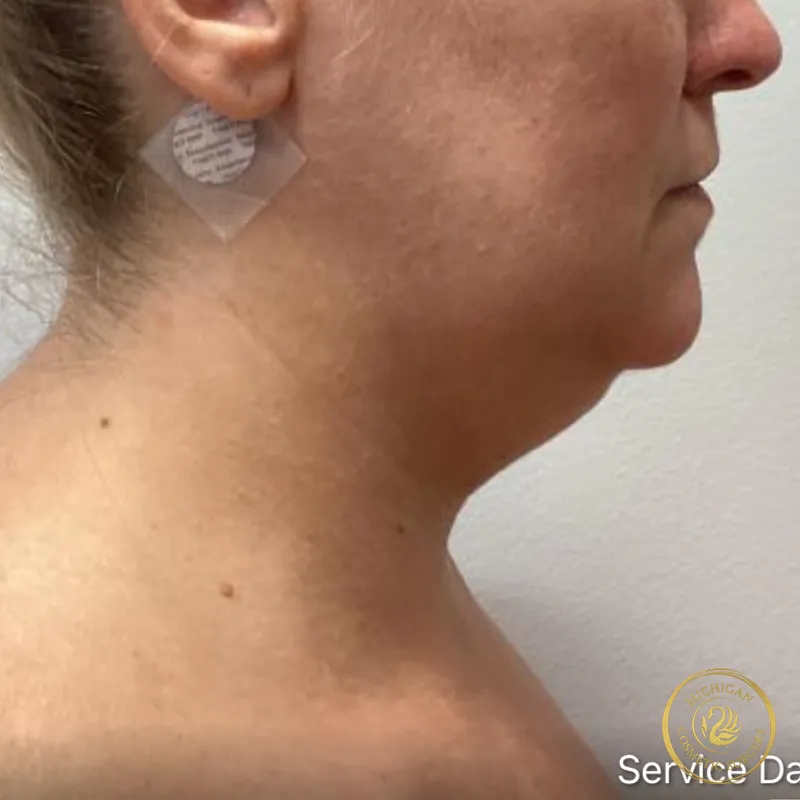 chin liposuction before photo by michigan cosmetic surgery in southfield mi