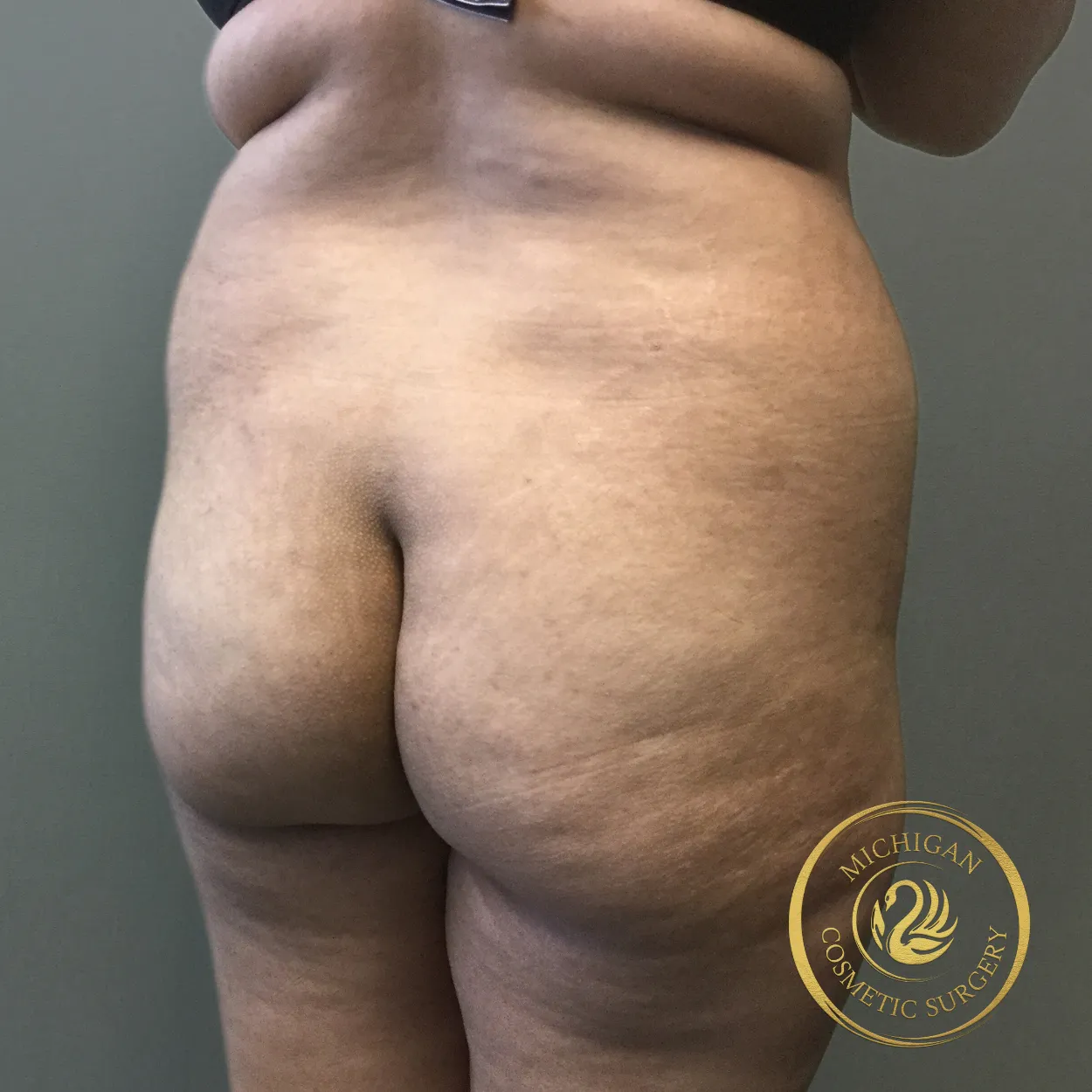 brazilian butt lift before photo by michigan cosmetic surgery in southfield mi