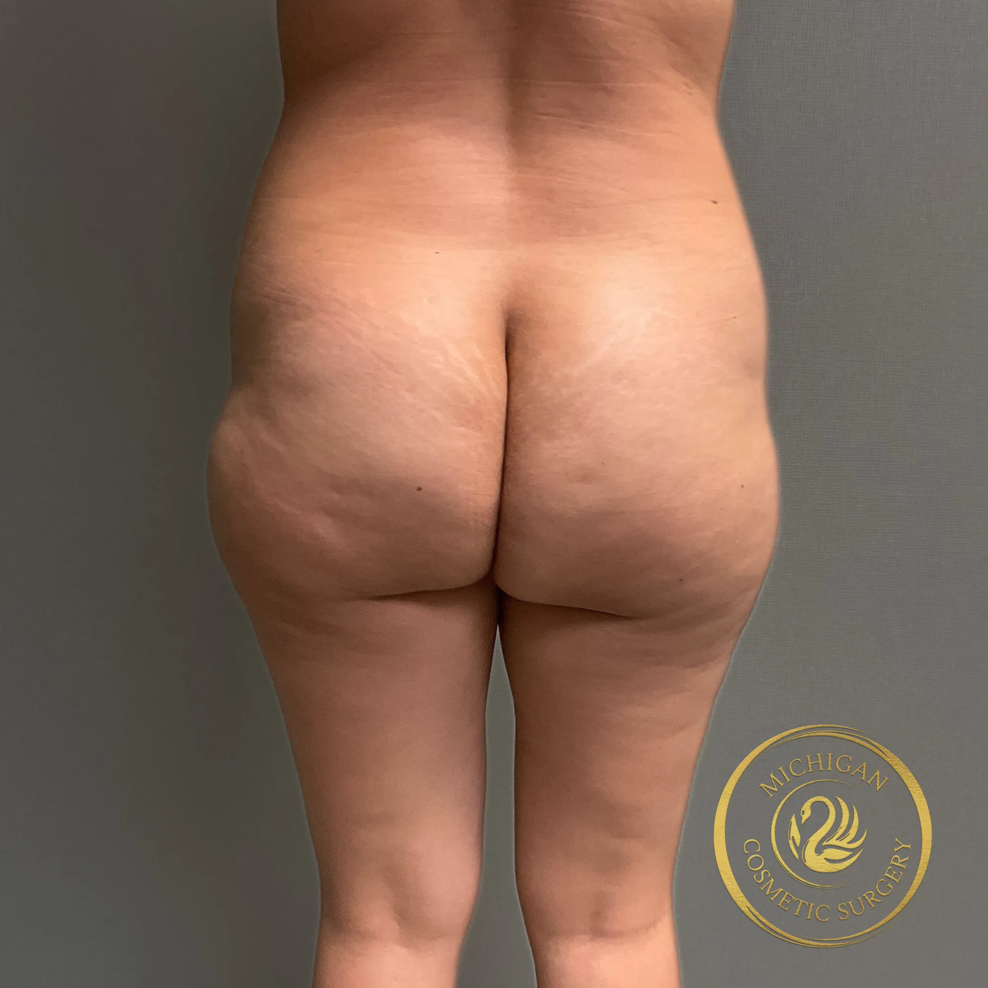 brazilian butt lift before photo by michigan cosmetic surgery in southfield mi