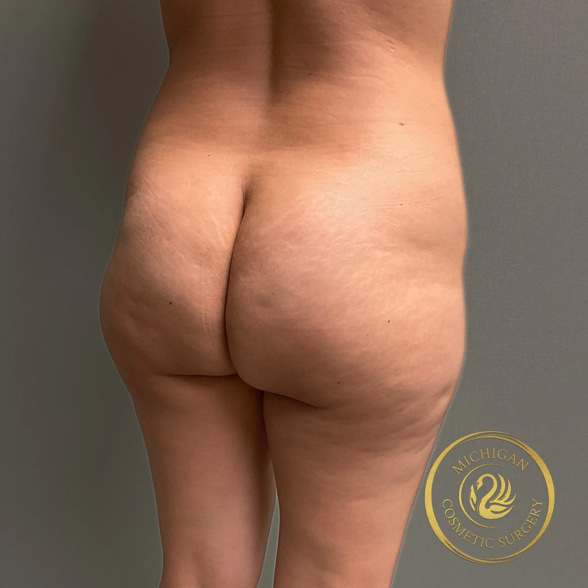 brazilian butt lift before photo by michigan cosmetic surgery in southfield mi