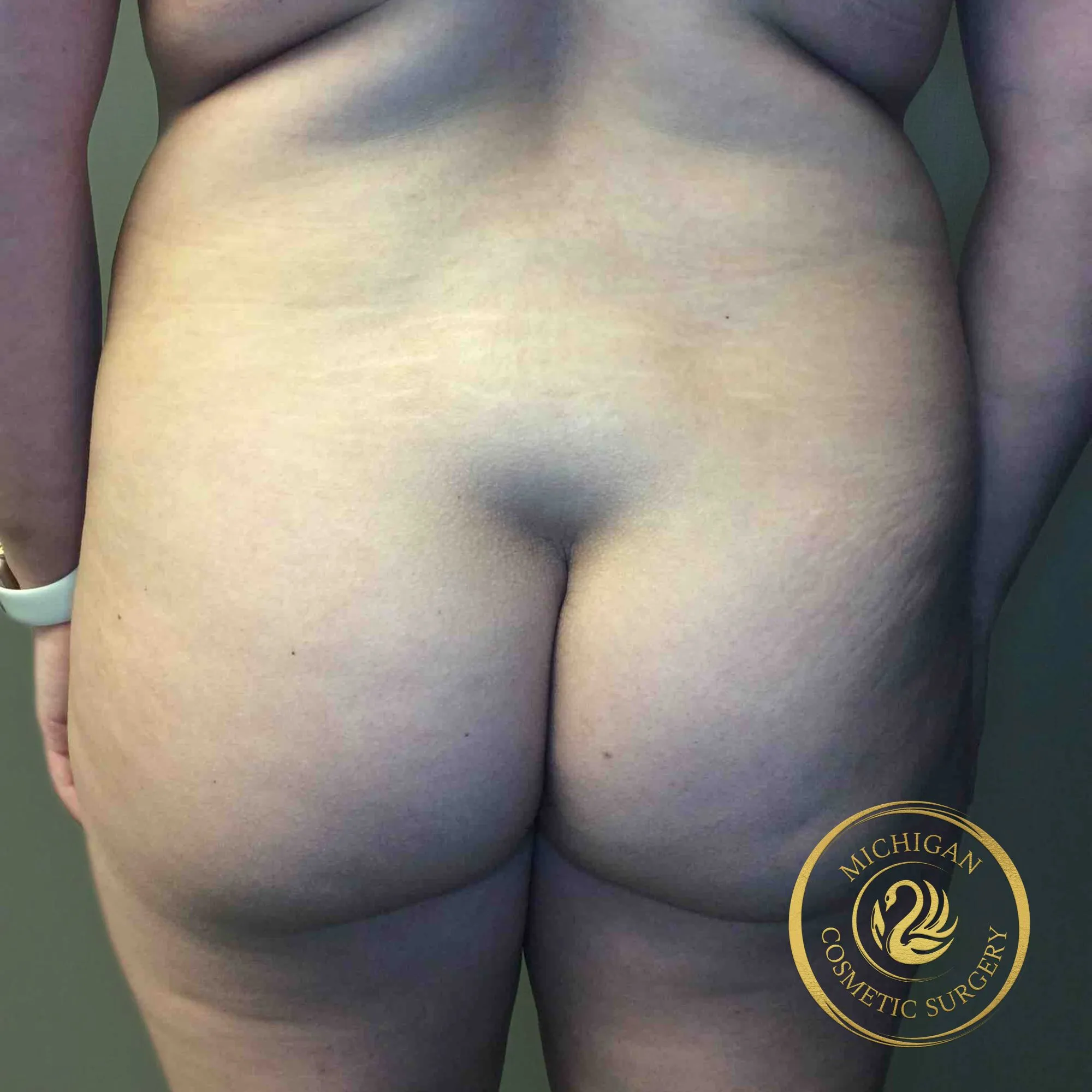 brazilian butt lift before photo by michigan cosmetic surgery in southfield mi