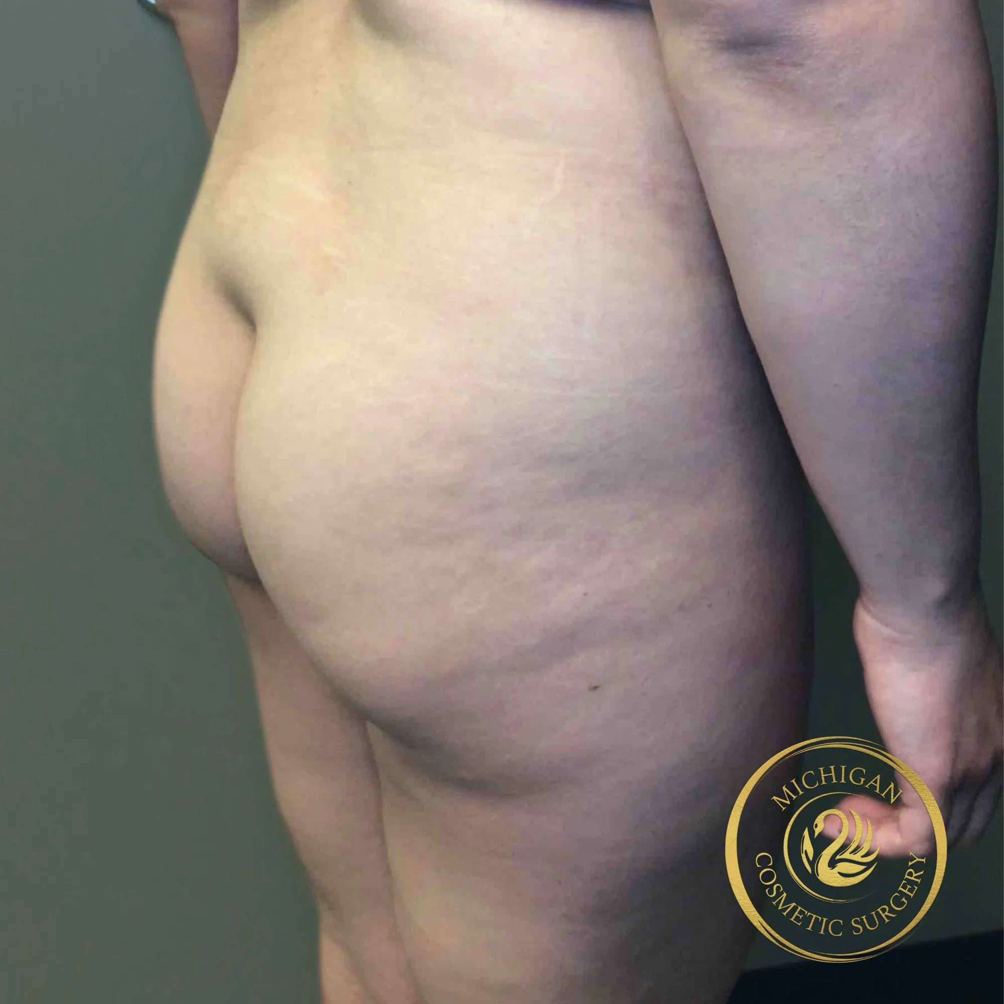brazilian butt lift before photo by michigan cosmetic surgery in southfield mi