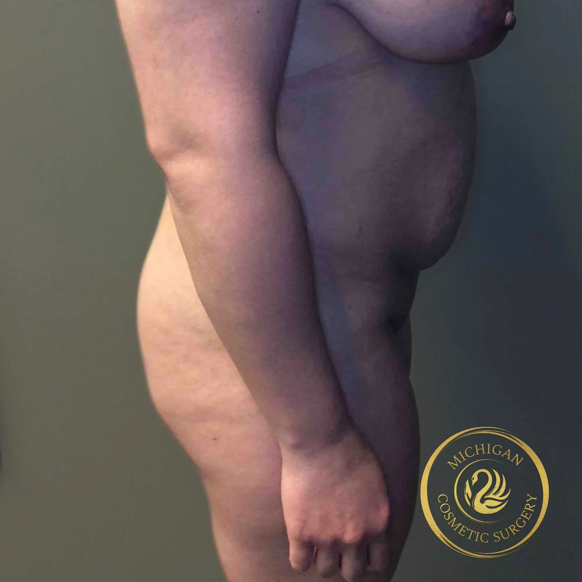 brazilian butt lift before photo by michigan cosmetic surgery in southfield mi