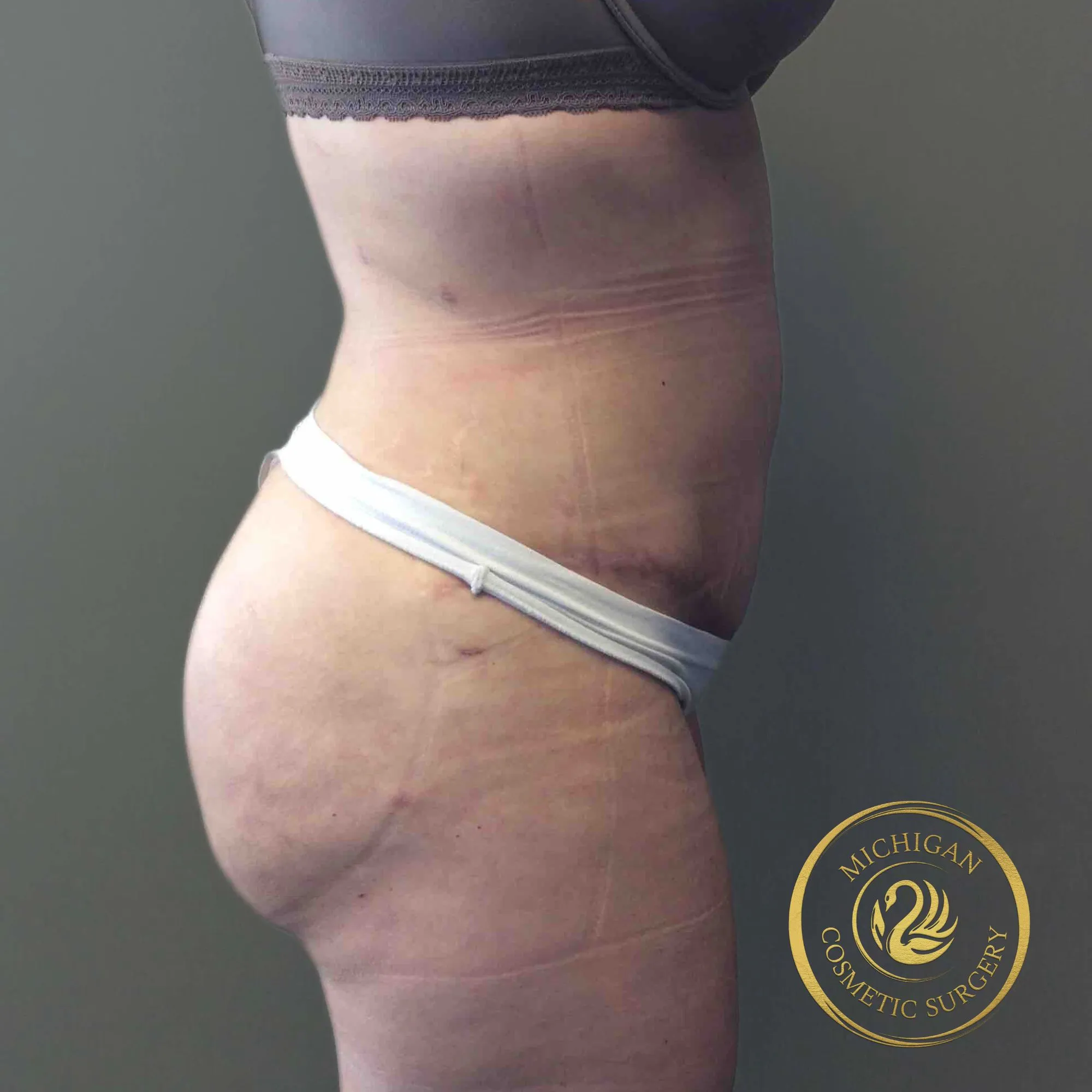 brazilian butt lift after photo by michigan cosmetic surgery in southfield mi