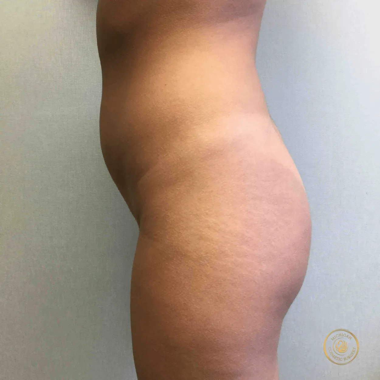 liposuction before photo by michigan cosmetic surgery in southfield mi