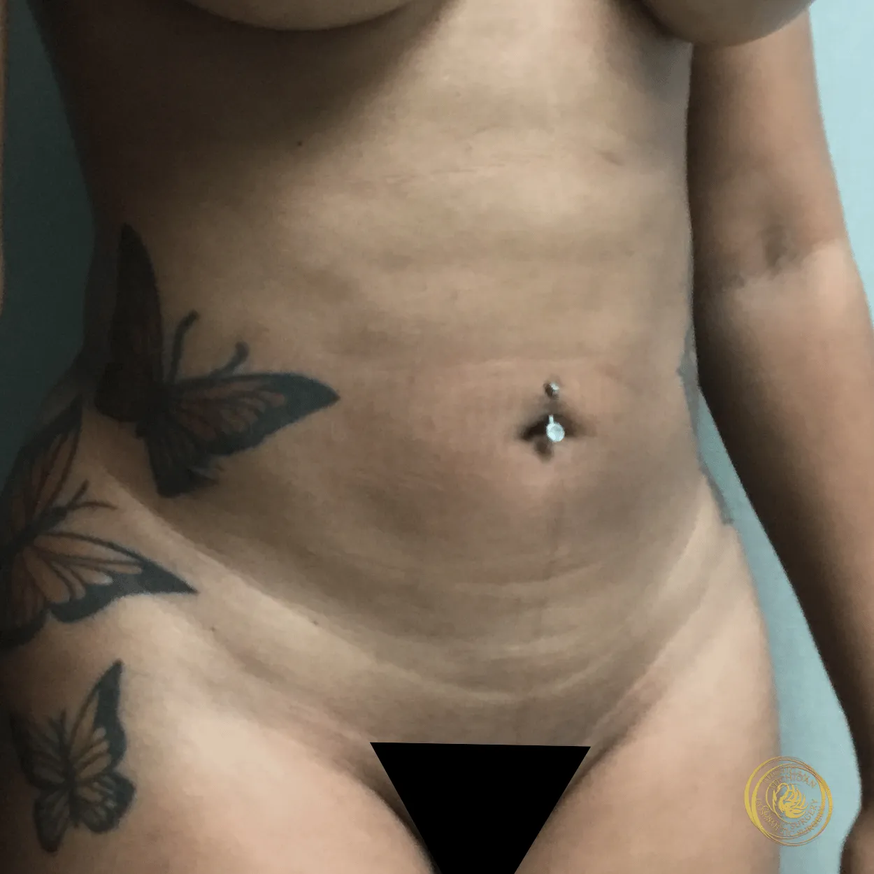 liposuction after photo by michigan cosmetic surgery in southfield mi