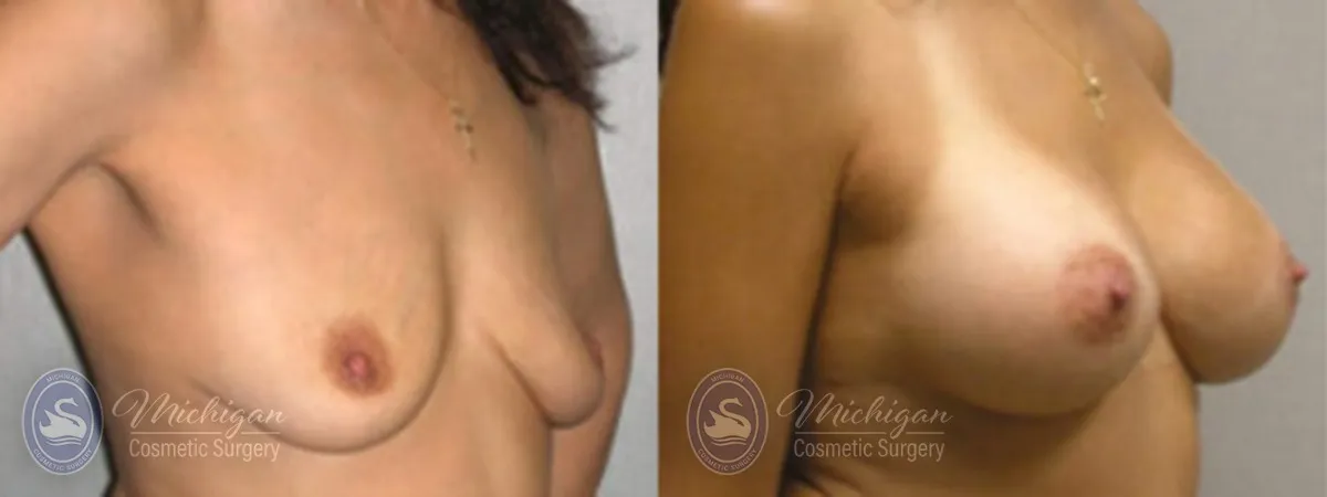 Michigan Cosmetic Surgery Southfield Breast Asymmetry P copy