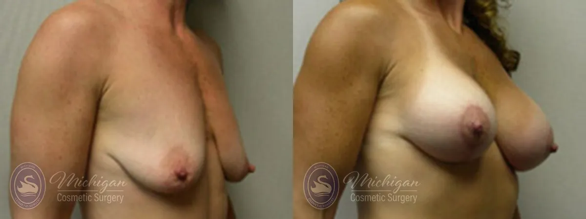Michigan Cosmetic Surgery Southfield Breast Augmentation Medium Lift P