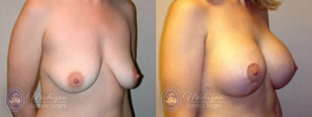 Michigan Cosmetic Surgery Southfield Breast Augmentation Medium Lift P