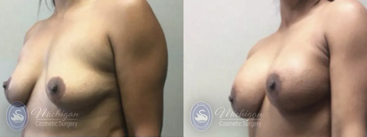 Michigan Cosmetic Surgery Southfield Breast Augmentation Medium Lift P