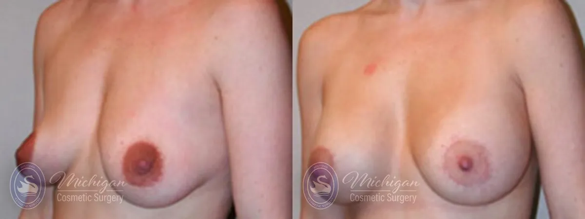 Michigan Cosmetic Surgery Southfield Breast Augmentation small lift P