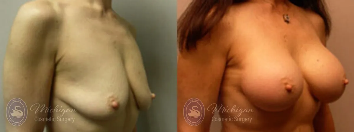 Michigan Cosmetic Surgery Southfield Breast Augmentation small lift P