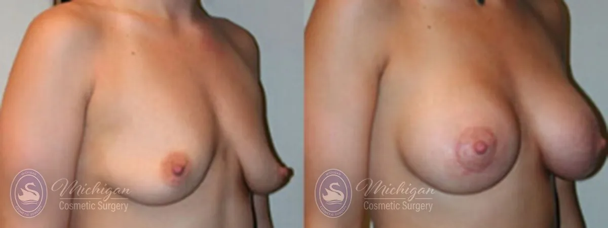 Michigan Cosmetic Surgery Southfield Breast Augmentation small lift P