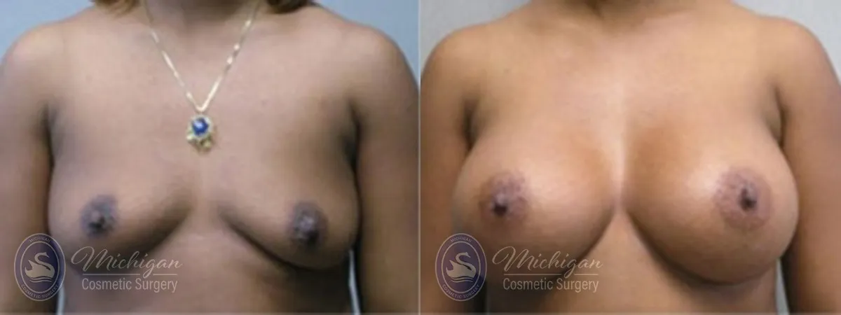 Michigan Cosmetic Surgery Southfield Breast Augmentation P