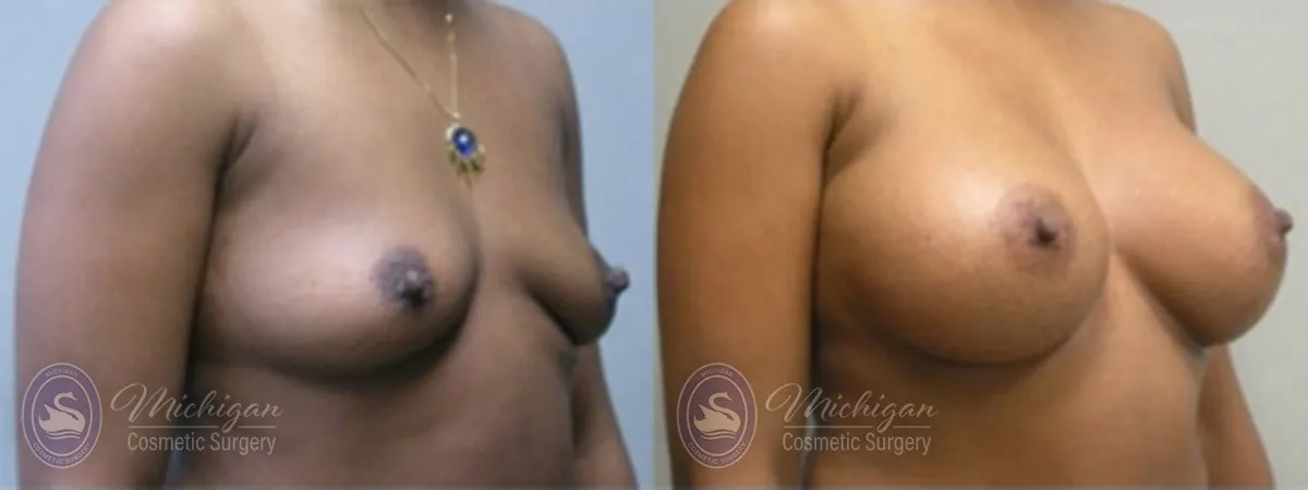 Michigan Cosmetic Surgery Southfield Breast Augmentation P
