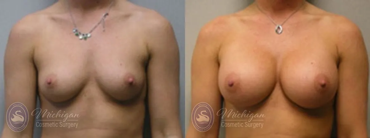 Michigan Cosmetic Surgery Southfield Breast Augmentation P