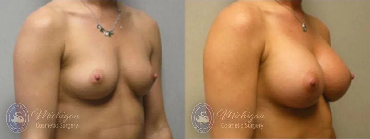 Michigan Cosmetic Surgery Southfield Breast Augmentation P