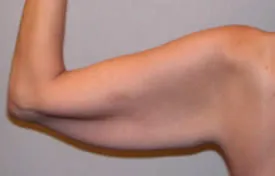 arm lift before photo by michigan cosmetic surgery in southfield mi