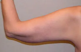 arm lift after photo by michigan cosmetic surgery in southfield mi