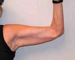 arm lift after photo by michigan cosmetic surgery in southfield mi