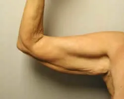 arm lift before photo by michigan cosmetic surgery in southfield mi