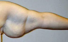 arm lift before photo by michigan cosmetic surgery in southfield mi