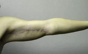 arm lift after photo by michigan cosmetic surgery in southfield mi