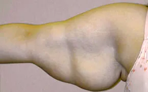 arm lift before photo by michigan cosmetic surgery in southfield mi