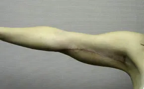 arm lift after photo by michigan cosmetic surgery in southfield mi