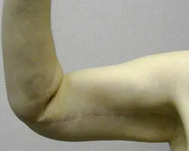 arm lift after photo by michigan cosmetic surgery in southfield mi