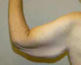 arm lift before photo by michigan cosmetic surgery in southfield mi