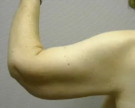 arm lift after photo by michigan cosmetic surgery in southfield mi