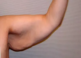 arm lift before photo by michigan cosmetic surgery in southfield mi