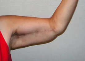 arm lift after photo by michigan cosmetic surgery in southfield mi