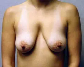 breast augmentation and lift before photo by michigan cosmetic surgery in southfield mi
