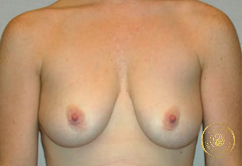 breast augmentation and lift before photo by michigan cosmetic surgery in southfield mi