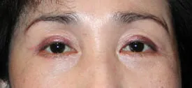 blepharoplasty after photo by michigan cosmetic surgery in southfield mi