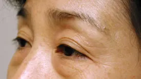 blepharoplasty before photo by michigan cosmetic surgery in southfield mi