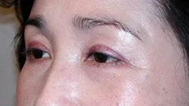 blepharoplasty after photo by michigan cosmetic surgery in southfield mi
