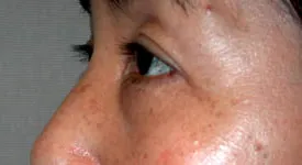 blepharoplasty after photo by michigan cosmetic surgery in southfield mi