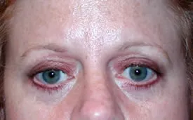 blepharoplasty after photo by michigan cosmetic surgery in southfield mi